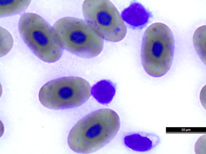 Fig 4 Lk lymph and thrombo sm