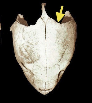 PostOccipSinus